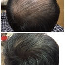 アルティバ成毛法99.8%髪を生やすのが仕事です。