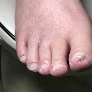 巻き爪施術！痛くない！怖くない！切って整えるだけ、【医療資格不要】の画像