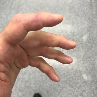 寒さで指がパンパン！の画像