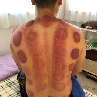 電気カッピング導入