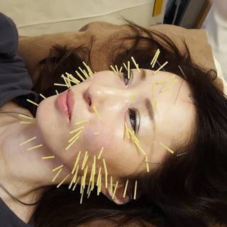 美容鍼コース　６６００円