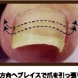出張  痛くない巻き爪矯正    通常4,500円が→ お試し価...