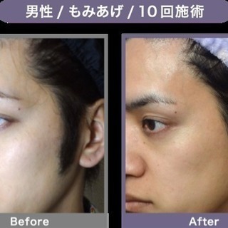 男性脱毛キャンペーン