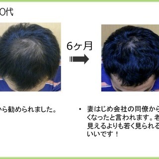 薄毛・抜け毛対策　発毛体験90分6480円受付中