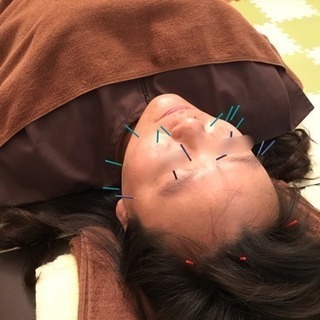 美容鍼による理想の健康美！！の画像