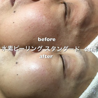 成城学園前 フェイシャル＊＊＊水素ピーリングで肌トラブル、老化の原因「活性酸素」を除去☆潤いのあるつや肌へ！朝9時より営業しています - 世田谷区