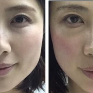 《顔痩せ・小顔・引き上げ》結果重視！写真は1回の施術例です✨まずは体験特別価格でお待ちしています❣️勧誘なし！ - 大阪市
