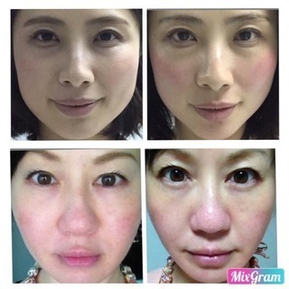《顔痩せ・小顔・引き上げ》結果重視！写真は1回の施術例です✨まずは体験特別価格でお待ちしています❣️勧誘なし！ − 大阪府