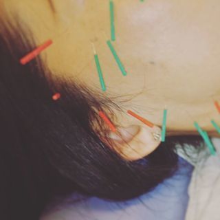 【ほうれい線】【シミ】【たるみ】和歌山 美容鍼ならすまいる整体院