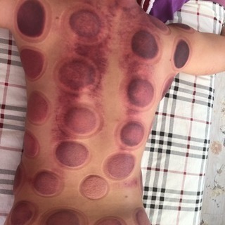 免疫力⤴️💪ダイエットと浮腫み（祛湿）カッピング❣️便秘や不眠症解消