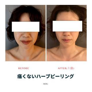 美肌再生専門サロンMOU(痛くないハーブピーリング&MOU式小顔術) - 渋谷区