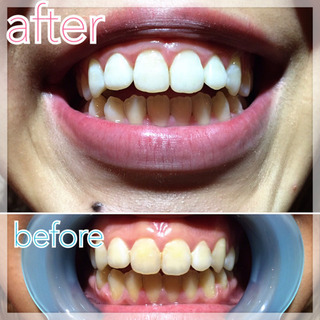 【急募】✨🦷セルフホワイトニング🦷✨未経験ok/資格無okの画像