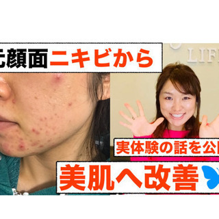 美肌づくり　美肌カウンセリング【ニキビ改善からアンチエイジングまで】