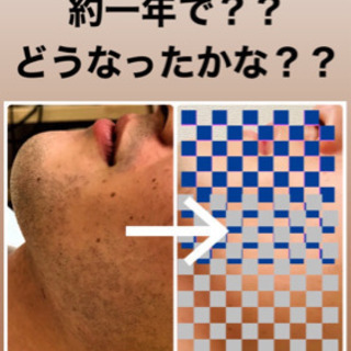 《毎朝の髭剃りとさようなら》　剛毛OK♪ヒゲ全体脱毛　通常￥18240→￥6980 - 名古屋市