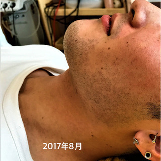 《毎朝の髭剃りとさようなら》　剛毛OK♪ヒゲ全体脱毛　通常￥18240→￥6980 - その他