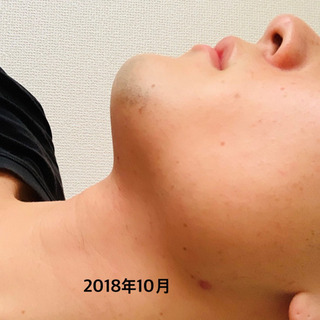 《毎朝の髭剃りとさようなら》　剛毛OK♪ヒゲ全体脱毛　通常￥18240→￥6980 − 愛知県