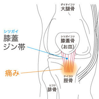 〜ジャンパー膝について〜