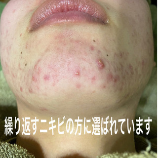 「何をすればニキビから解放されるのだろう」という方に選ばれています
