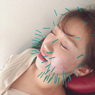 仙台で美容はり！！