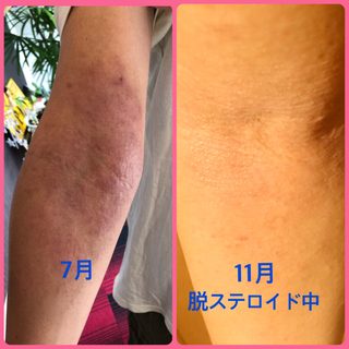アトピー＆アレルギー克服整体　なぜ整体でアトピー＆アレルギーが克...
