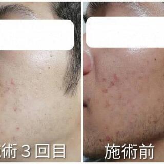 沖縄初導入!肌再生vos　メンズokサロン！もちろん子供同伴👌okです