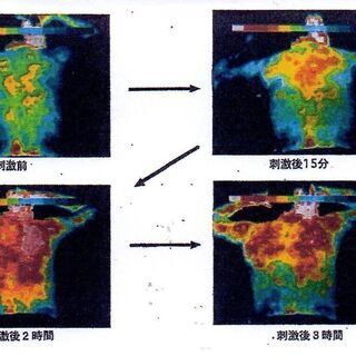 刺さない針で身体のケアを！！今プロアスリートも注目のウエルアップ...