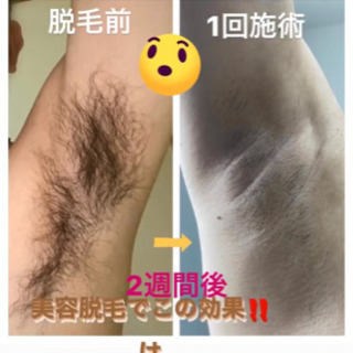 メンズVIO脱毛 1回3,000円 5分で完了のセルフ脱毛 - 美容