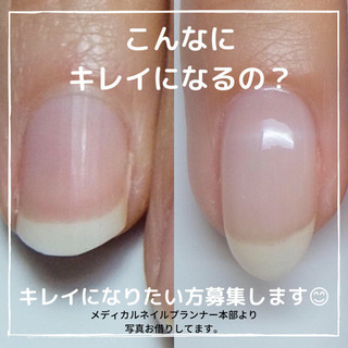 自爪改善モニター募集