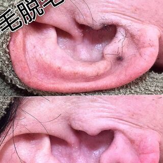 【四ツ谷三丁目 徒歩２分】男性限定メニュー 耳毛脱毛 サロンの画像