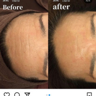 今大流行中のヒト臍帯血幹細胞美容液のサンプルプレゼント💕の画像