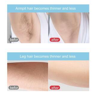 新品★フェイシャルボディ永久ヘアリムーバーデバイスレーザー脱毛器の画像