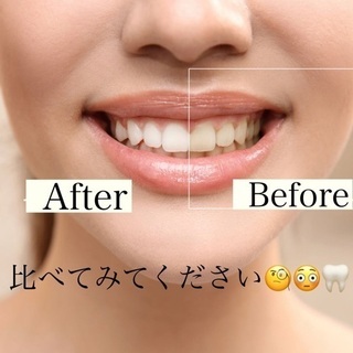 ホワイトニングサロンで歯を白くして−5歳若返り😍🦷