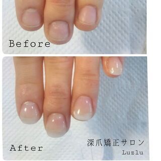 表参道ネイル💅深爪矯正✨噛爪/むしり爪...