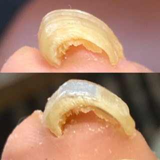 巻爪矯正の経過が楽しみなお客様、ご来店‼️