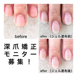 ☆深爪矯正無料モニター募集☆