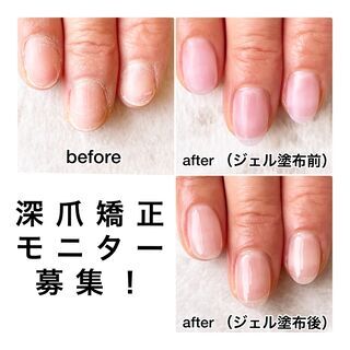 ☆深爪矯正無料モニター募集☆ - 品川区