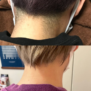 襟足も脱毛