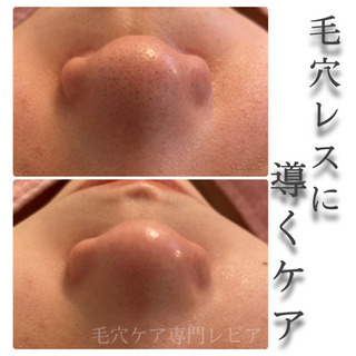 那覇/おもろまちサロン/今話題の毛穴エクストラクション✨