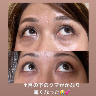 凄い効果‼︎   目の下のクマが薄くなった‼︎