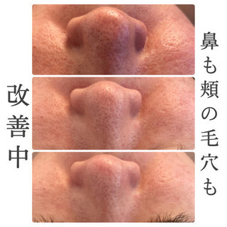 沖縄上陸！今SNSでも話題の毛穴エクストラクションの画像