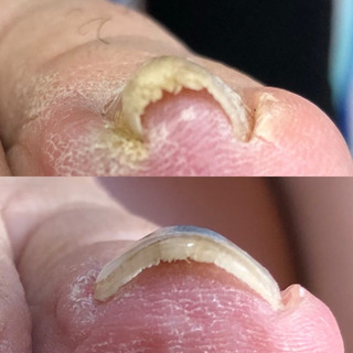 8回の施術、見違えるほどの改善てす‼️