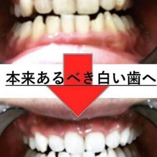1回￥2200　隠れ家サロンでセルフホワイトニング☆彡 - 神戸市