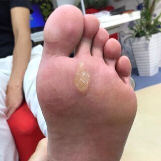 肩こりなど身体に不調をお持ちで、足裏にこんな症状をお持ちの方、必見！