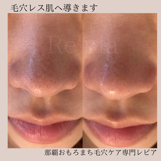 長年の黒ずみ劇的変化