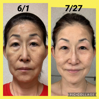 シミ　しわ　たるみ　角質ケア　アンチエイジング - 地元のお店