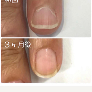 爪のお悩み解消