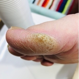 小爪(副爪)も角質も綺麗になりました‼️ - ボディケア