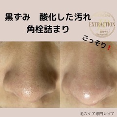 黒ずみ・角栓詰まりには毛穴エクストラクション！