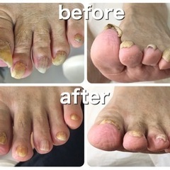 高齢者フットケア、足の爪切りボランティアの画像