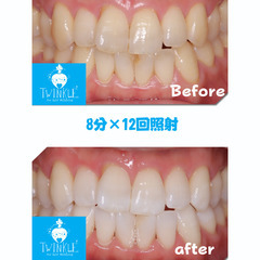 ✨リニューアルオープン🎉✨【上尾駅東口駅前】歯のセルフホワイトニング専門店ティンクルホワイト☆彡　 - 上尾市